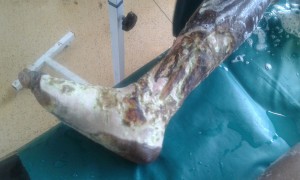 A lower leg in bad shape due to massive infection. It was amputated.